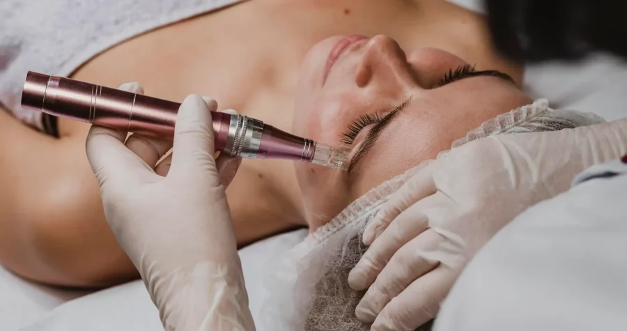 Microneedling